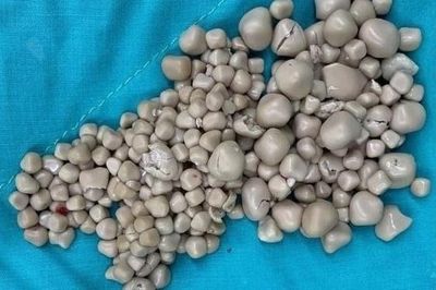 Những dấu hiệu cảnh báo sỏi thận giai đoạn đầu