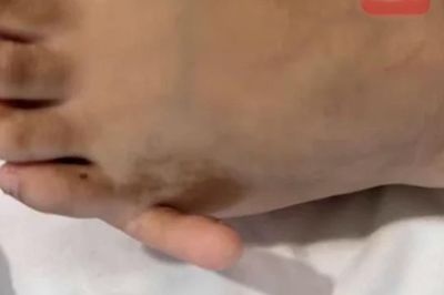 Cô gái 17 tuổi có 6 ngón tay 'mọc' ra và sự thật bất ngờ