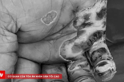 Bỏng nặng vì thả diều gần đường điện cao thế