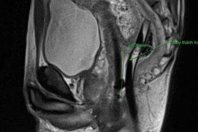 Cứu sống bệnh nhân 42 tuổi bị đứt rời trực tràng