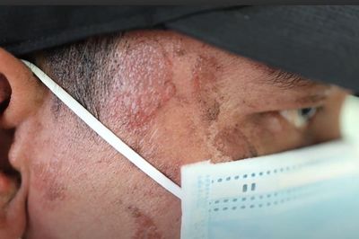 Vì sao kiến ba khoang không cắn vẫn gây độc tố rắn hổ mang?