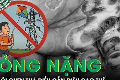 Người đàn ông 57 tuổi bỏng nặng vì thói quen thả diều gần điện cao thế