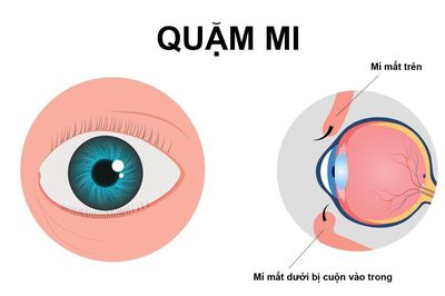 Quặm mi - khi lông mi âm thầm 'cào xước' giác mạc mỗi ngày