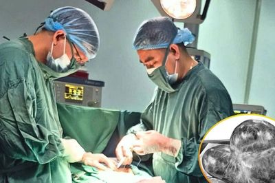 Phẫu thuật thành công khối u buồng trứng nặng 5kg ở phụ nữ lớn tuổi