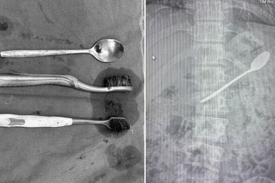 Tìm thấy nhiều bàn chải đánh răng, thìa inox trong dạ dày nam thanh niên Hà Nội