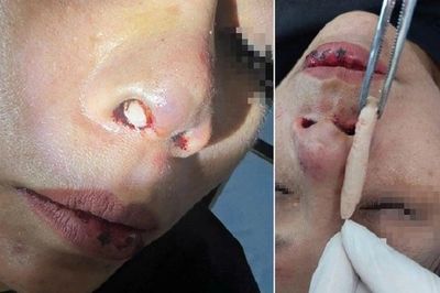 Tai nạn giao thông làm lộ sụn nâng mũi, nữ bệnh nhân nguy cơ nhiễm trùng cao