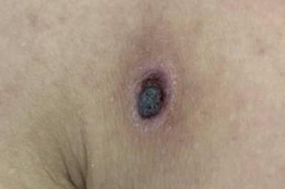 Bệnh nhân nguy kịch vì vết đốt không đau, không ngứa