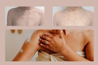Bệnh vảy cá bẩm sinh và những hệ lụy khi lơ là chăm sóc da