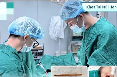 Ngậm đũa khi chơi, bé 2 tuổi suýt thủng sọ não