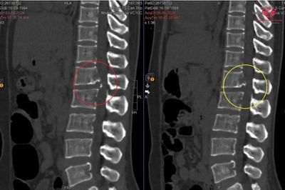 Đau lưng sau mang vật nặng, người phụ nữ thoát vị đĩa đệm sát tủy sống