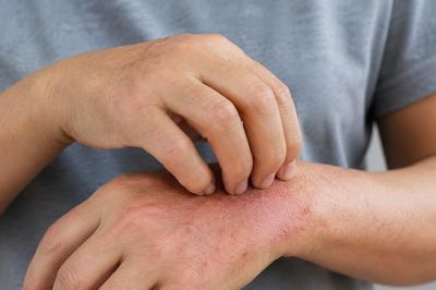 Ngứa ở 2 vị trí trên cơ thể có nguy cơ là biểu hiện xơ gan