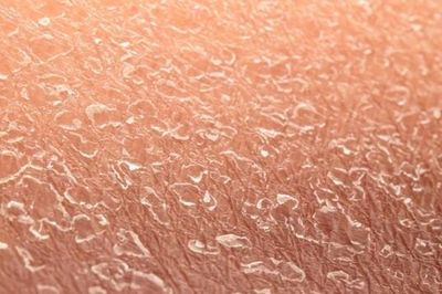 Bệnh hiếm khiến làn da liên tục bong tróc suốt đời