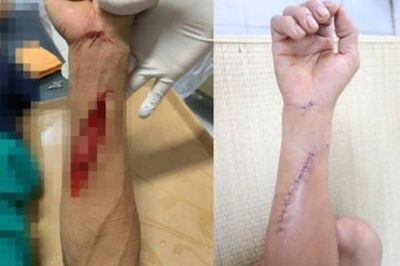Bị kính vỡ cắt phải, người đàn ông suýt mất chức năng bàn tay do đứt gân, tổn thương nặng