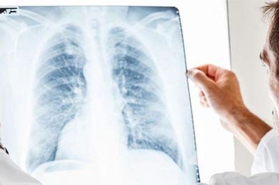 Vaccine ADN đường mũi mở hướng mới trong điều trị lao