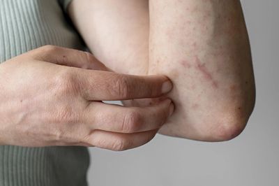 Gặp triệu chứng này, suy nghĩ đến xổ giun ngay