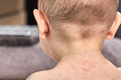 Mỹ đối mặt nguy cơ bùng phát dịch sởi tồi tệ nhất sau 35 năm
