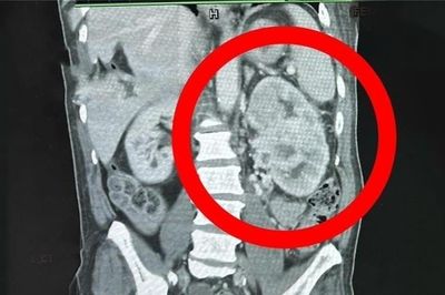 Có 2 dấu hiệu ung thư thận nhưng người đàn ông không hay biết
