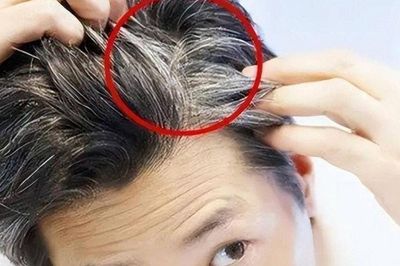 Tóc trắng mọc trên trán, thái dương và sau đầu cảnh báo điều gì? 7 việc cần làm để tóc luôn đen nhánh