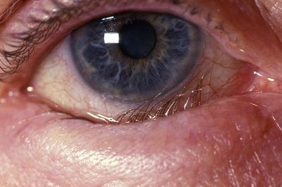 Quặm mi có thể gây tổn thương giác mạc