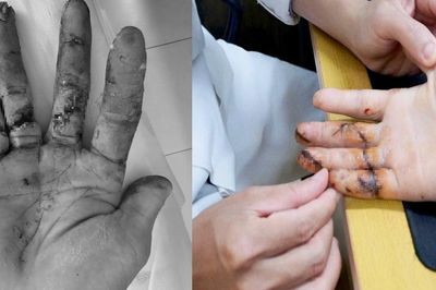 Ngày đầu đi làm, thanh niên 17 tuổi suýt mất 3 ngón tay vì máy cưa