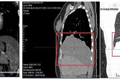 Đi khám vì đau tức ngực và ho khan, cô gái phát hiện khối u gần 15cm