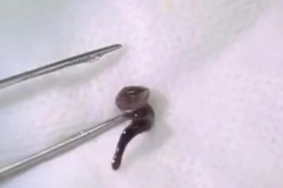 Người đàn ông 24 tuổi chảy máu mũi sau khi uống nước suối, bác sĩ phát hiện 'bí mật đáng sợ'