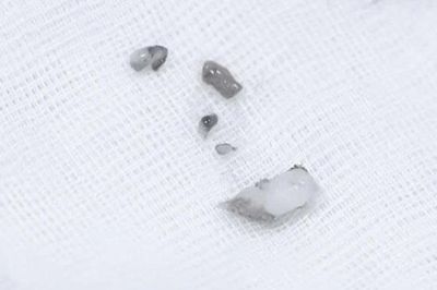 Hy hữu: Phát hiện răng mọc trong hốc mũi của bé 8 tuổi