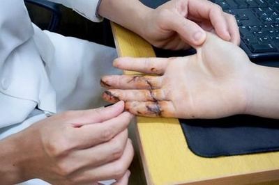 Bác sĩ cảnh báo tai nạn lao động từ việc sử dụng máy cưa không đúng cách
