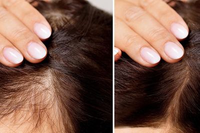 Rụng tóc mất kiểm soát ở tuổi 20, cô gái đi khám phát hiện nguyên nhân bất ngờ