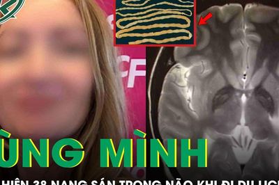 Rùng mình: Cô gái tá hỏa phát hiện 38 nang sán trong não