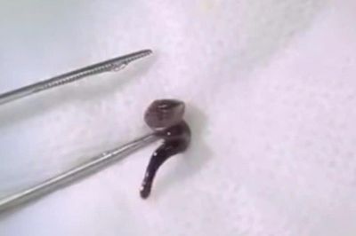 Uống nước ở suối, nam thanh niên bị con đỉa dài 2,5cm chui vào mũi