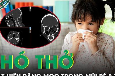 Bác sĩ phát hiện nguyên nhân bất ngờ khiến bé gái 8 tuổi nghẹt mũi nhiều năm