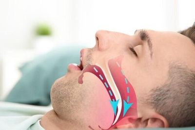 Ngáy to kéo dài, chuyên gia cảnh báo nguy cơ ngưng thở khi ngủ