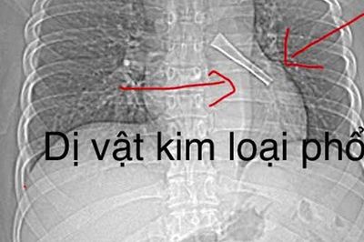 Ho không dứt, bác sĩ phát hiện cán thìa inox mắc trong phế quản bệnh nhân