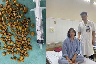 Bác sĩ lấy ra hàng trăm viên sỏi trong túi mật của nữ bệnh nhân 39 tuổi