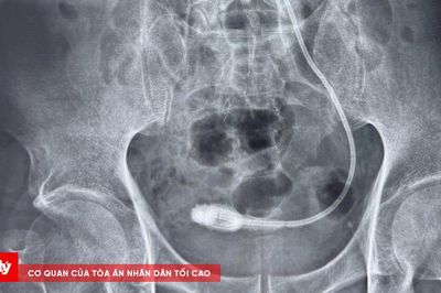 Người đàn ông mang ống Sonde JJ trong cơ thể suốt 9 năm
