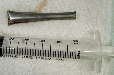 Cán thìa inox 'ẩn náu' trong phế quản người đàn ông