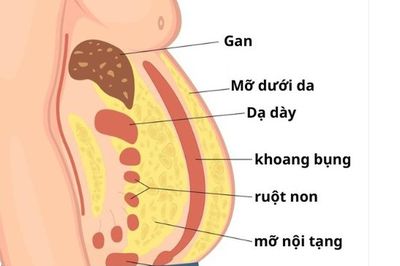 Mỡ nội tạng nguy hiểm hơn mỡ dưới da như thế nào?