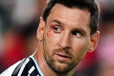 Messi rách mí mắt vì khuỷu tay Xhaka, vẫn chiến đấu đưa Argentina vào bán kết