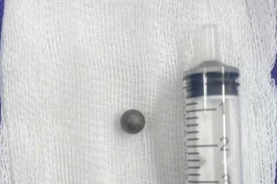 Bé 6 tuổi nhập viện với viên bi sắt nằm ở vị trí nguy hiểm vùng đầu mặt