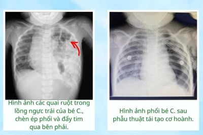 Ho kéo dài, bé gái 17 tháng tuổi phát hiện thoát vị hoành hiếm gặp
