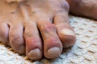 Hạt tophi ở người bệnh gout khi nào cần xử trí?
