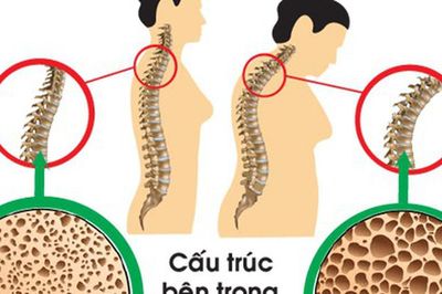 Tuổi nào bắt đầu bị loãng xương và cách phòng bệnh hiệu quả từ sớm