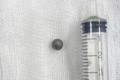 Bé trai 6 tuổi bị viên bi sắt xuyên vào xoang bướm khi chơi súng cao su