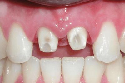 Trước khi mài răng để bọc sứ, đừng quên 4 câu hỏi này