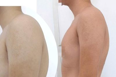 Điều trị gù lưng không cần phẫu thuật