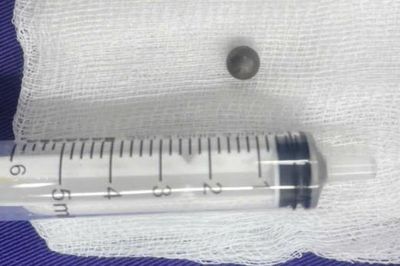 Chơi súng bắn bi khiến trẻ 6 tuổi phải phẫu thuật nội soi lấy dị vật trong mũi