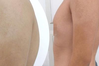 Thói quen ngồi học sai nhiều năm khiến cột sống nam sinh gù vẹo nghiêm trọng