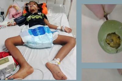 Hai trẻ hôn mê, suy hô hấp: Bác sĩ cảnh báo nguy cơ ngộ độc khi ăn chanh dây chưa chín