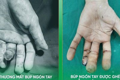 Thêm giải pháp tạo hình cho người bị khuyết hổng đầu ngón tay